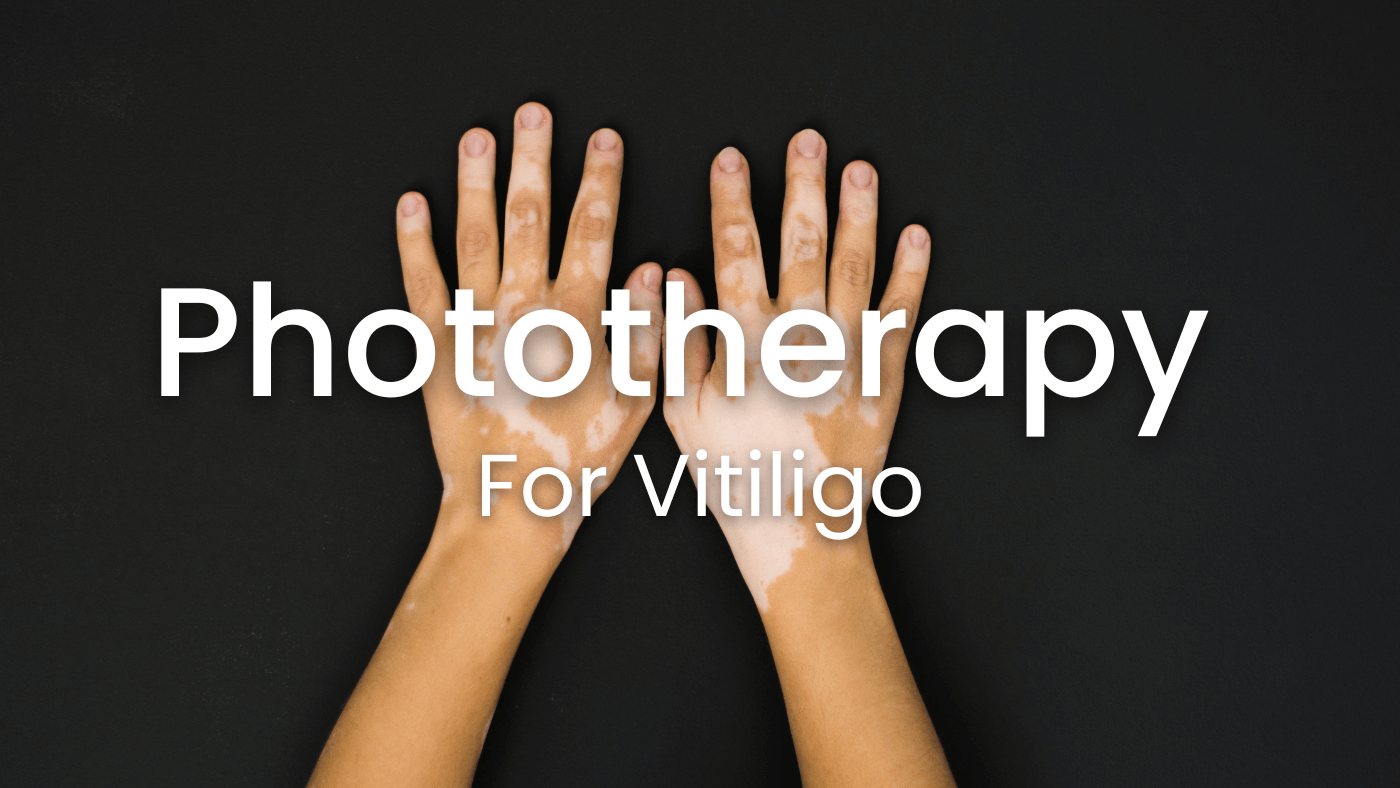 Phototherapy for Vitiligo